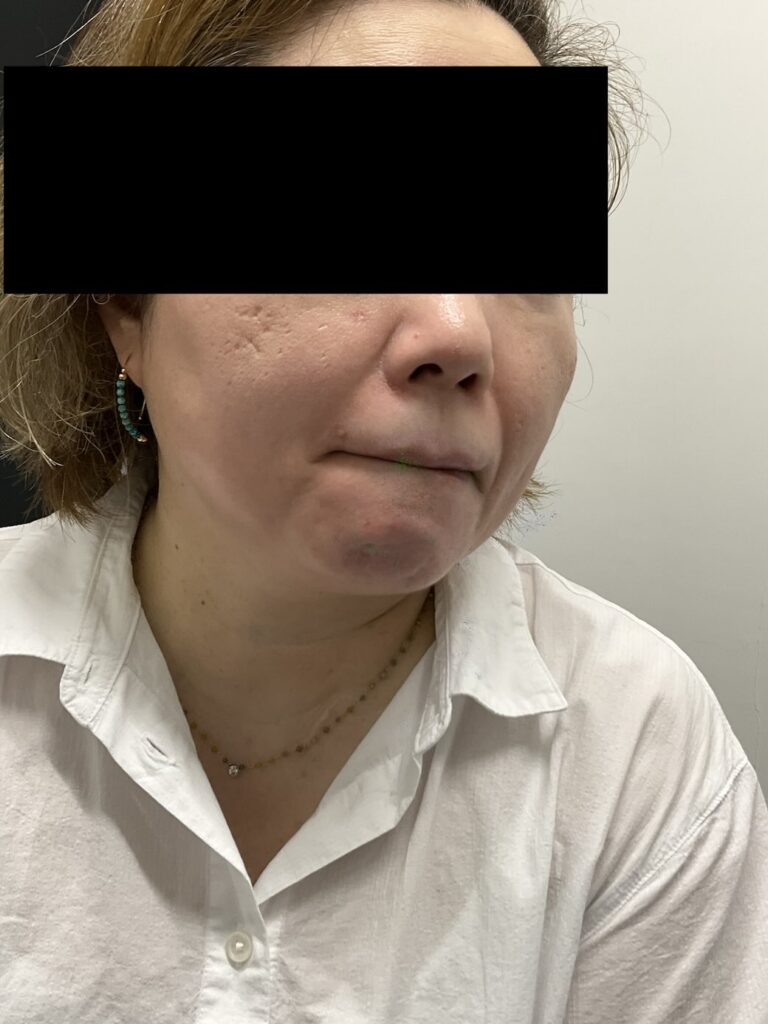 【症例紹介】50代女性・右ほほのニキビ跡に対するダーマペン治療（2025年8月3日更新）
