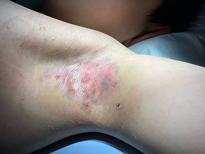 【症例紹介】20代男性・ワキガ・多汗症に対する手術治療（剪除法）（2025年8月3日更新）