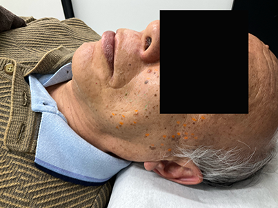 【症例紹介】80代男性・顔の老人性イボ(脂漏性角化症)に対する炭酸ガスレーザー治療(2025年8月3日更新)