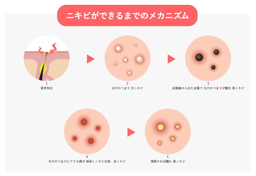 ニキビができるメカニズムを説明した図