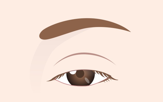 Ptosis leve