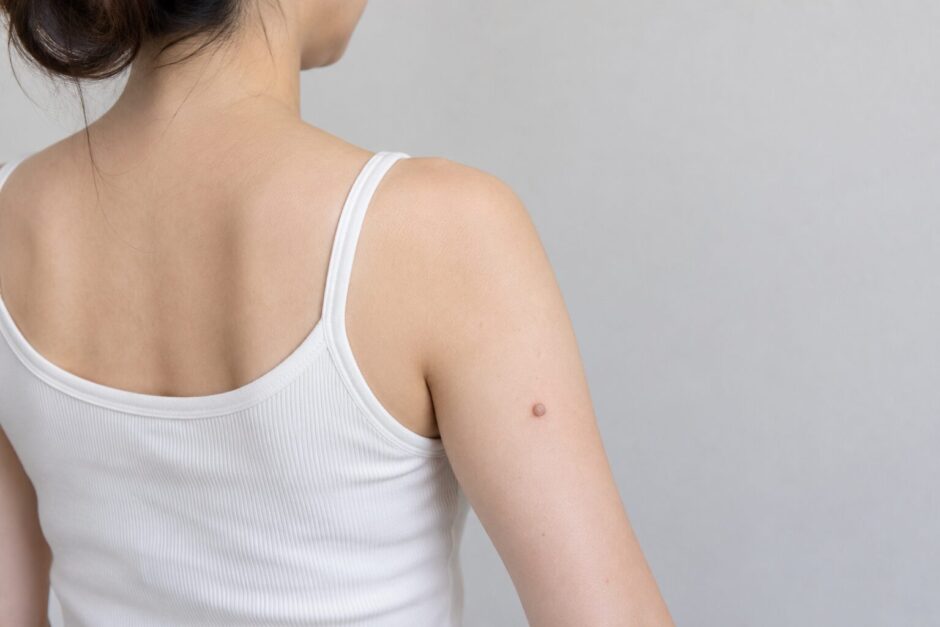 腕にイボがある女性